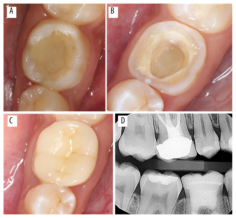 (A) Preoperative view of right mandibular first molar, (B) view after RCT and intra-pulpal extension, (C) view with cemented endocrown, and (D) postoperative bite-wing radiograph.