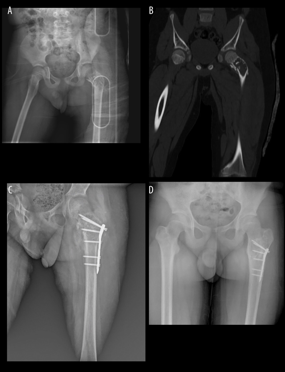 (A) Preoperative X-ray of an 8-year-old boy (Case 1). (B) Preoperative CT of Case 1. (C) Early postoperative X-Ray of Case 1. (D) Postoperative 8. year X-ray Case 1.