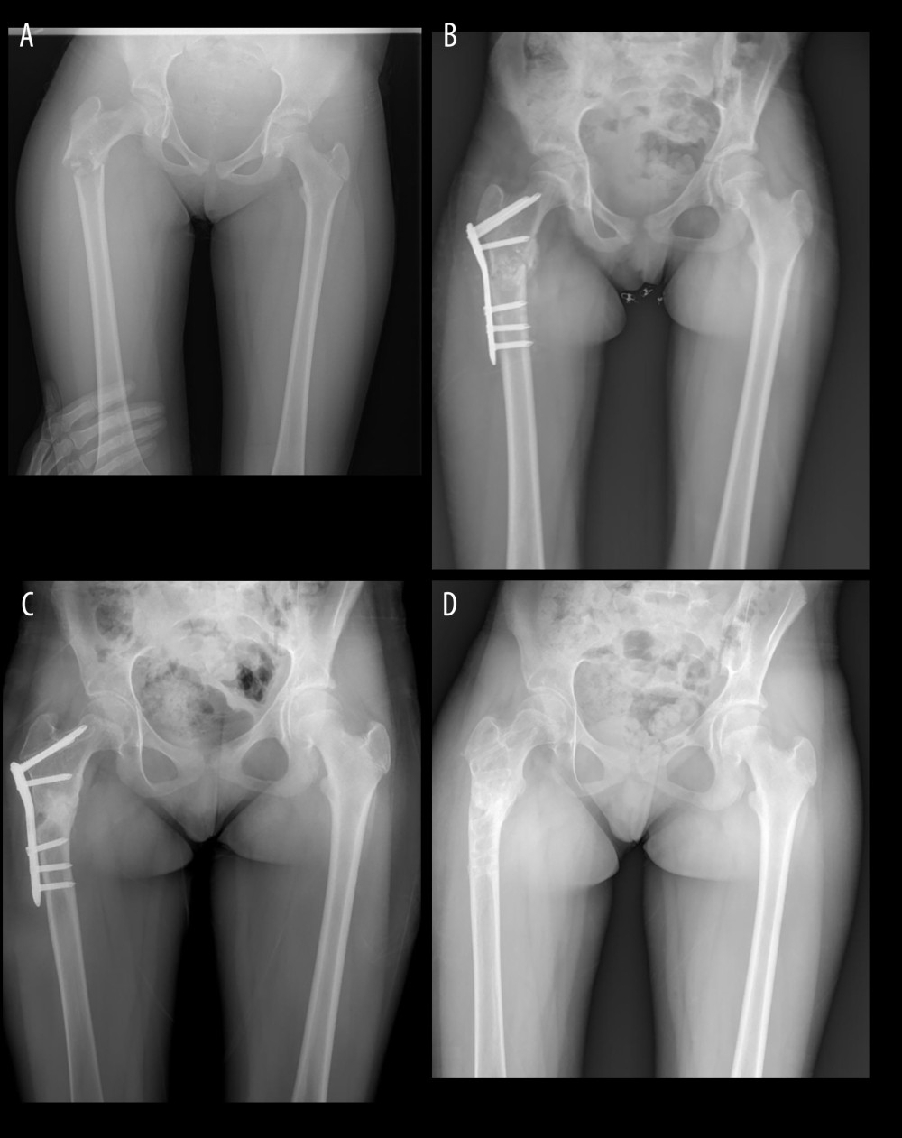(A) Preoperative X-ray of a 12-year-old girl (Case 3). (B) Early postoperative X-ray of Case 3. (C) Postoperative 10. Month X-ray of Case 3. (D) Postoperative 2. year X-ray of Case 3.