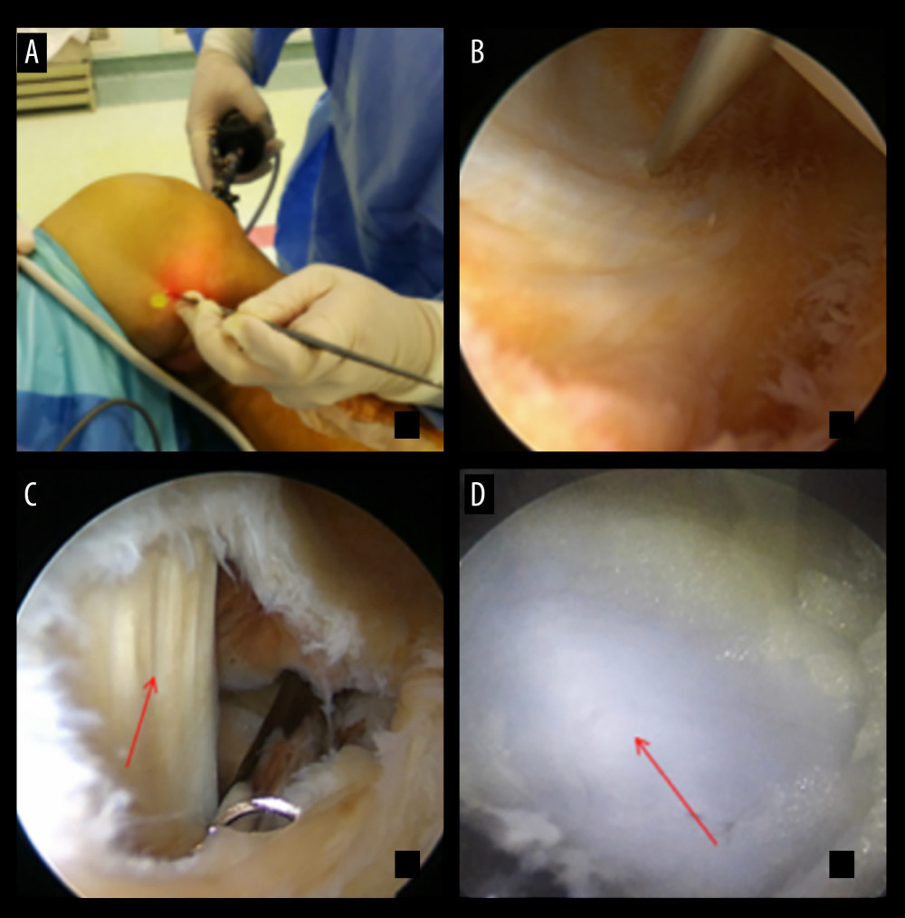 Surgical procedure. (A, B) The posterior medial approach is established under the knee quadratus. (C) The medial head of the gastrocnemius muscle (arrow) and semembranosus is exposed after excision of the capsular crease. (D) The popliteal cyst (arrow) can be exposed posteriorly medial to the medial head of the gastrocnemius muscle, which is very faint and difficult to see without methylene blue staining.