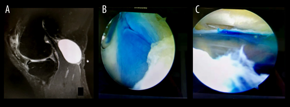 Arthroscopic visualization of popliteal cysts after methylene blue staining. (A) MRI shows a popliteal cyst located posteriorly within the medial head of the gastrocnemius muscle. (B) Methylene blue staining after drainage of the cystic fluid shows the extent of the cyst wall, which can be clearly identified, thus enabling complete excision of the cyst wall to reduce the recurrence rate of the cyst. (C) Performance after excision of the medial wall of the popliteal cyst.