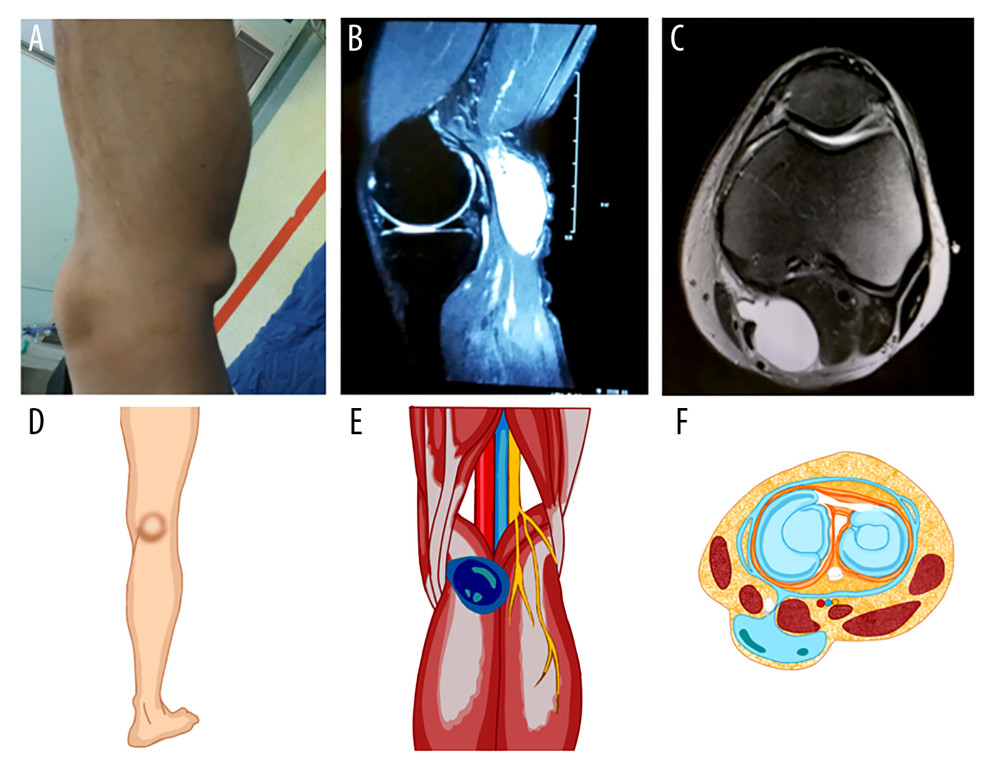 Popliteal cyst: (A) A significant cyst is seen in the posterior popliteal fossa. (B) MRI T2-weighted image shows a homogeneous high signal mass in the posterior part of the popliteal fossa. (C) Horizontal MRI shows that the popliteal cyst is located between the medial head of the gastrocnemius muscle and the semimembranosus muscle. (D–F) Schematic diagram of location of popliteal cysts, anatomical structures and horizontal planes.