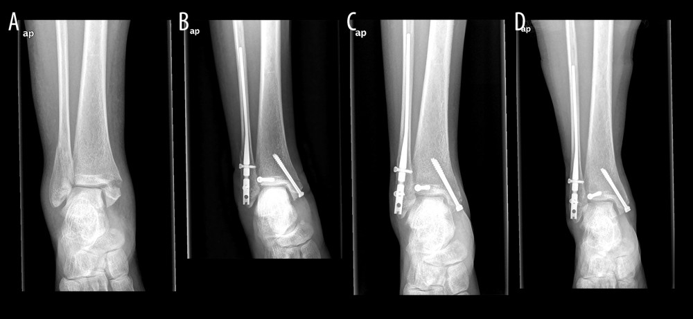 Typical case from the nail fixation group(A) Supination external rotation type IV injury. X-ray image showed displaced fractures of medial and lateral malleoli. (B) Immediately postoperative image showed intramedullary nail was used. (C) The nail position was good at 3 months after surgery. (D) The fracture completely healed at 1 year after surgery.