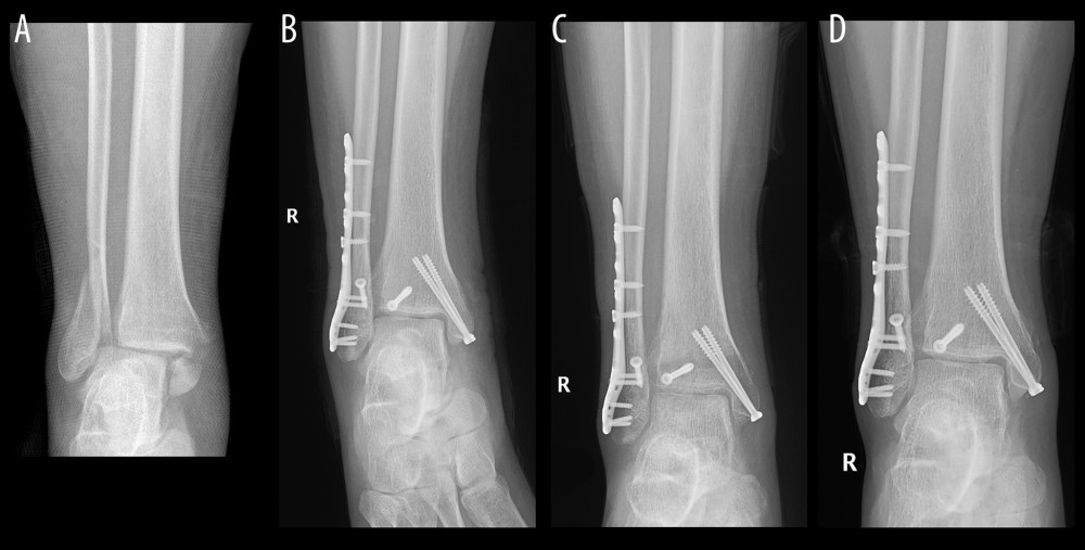 Typical case from the plate group(A) Supination external rotation type IV injury: X-ray image showed displaced fractures of medial and lateral malleoli. (B) Immediately postoperative image showed plate was used. (C) The fixation position was good at 3 months after surgery. (D) The fracture completely healed at 1 year after surgery.