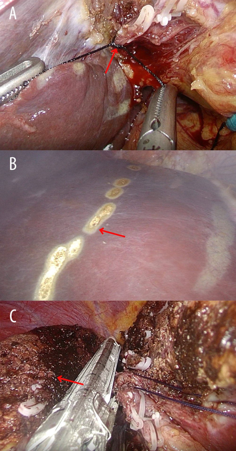 Intraoperative images of the laparoscopic right hemi-hepatectomy. (A) The right hepatic hilar was controlled (red arrow). (B) The resection guideline was based on the ischemic boundary (red arrow). (C) The hepatic parenchyma was transected and the right hemi-liver (red arrow) removed.