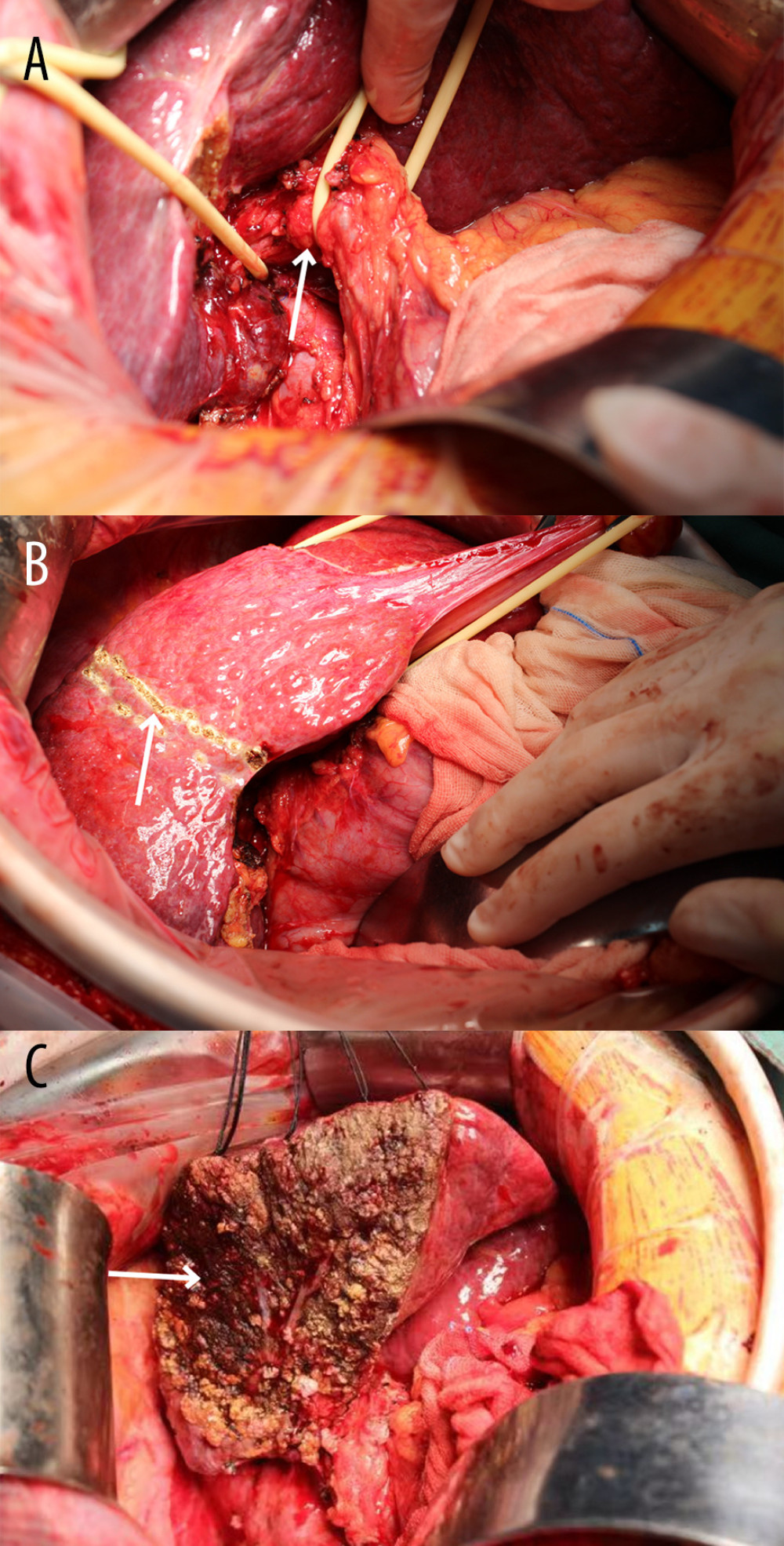 Intraoperative images of the open right hemi-hepatectomy. (A) Control of the first hepatic portal (white arrow). (B) Resection guideline based on the ischemic boundary (white arrow). (C) The right hemi-liver is resected and removed. The left hemi-liver remains (white arrow).