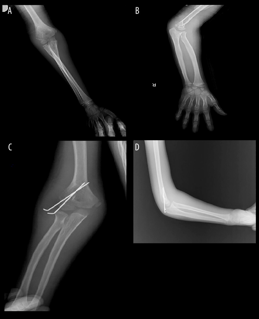 (A–D) An 8-year-old male patient presenting with a lateral condyle fracture after a playground injury underwent closed reduction and percutaneous pinning. Figure 1 was captured as a screenshot from the PACS Infinitt system used in the hospital and transferred to the computer. No additional processing was performed.