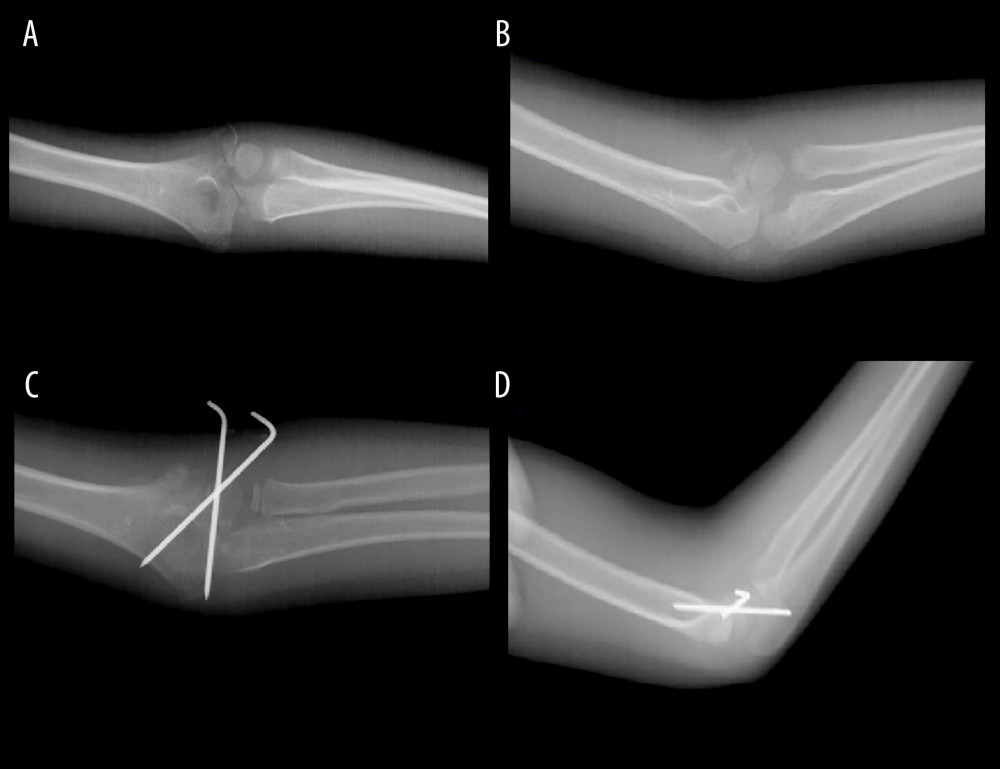 (A–D) The patient with a lateral condyle fracture following a simple fall presented to our facility 3 weeks after the injury. Open reduction and fixation with Kirschner wires were performed for the displaced fracture. Figure 2 was captured as a screenshot from the PACS Infinitt system used in the hospital and transferred to the computer. No additional processing was performed.
