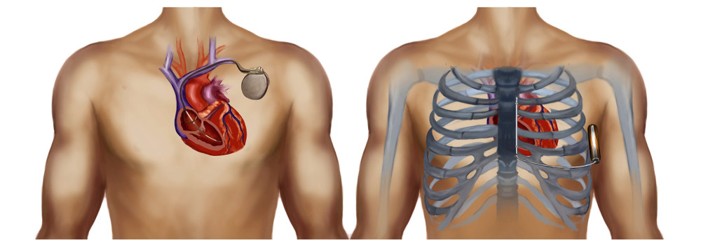 Schematic diagram of S-ICD (right) and TV-ICD (left).