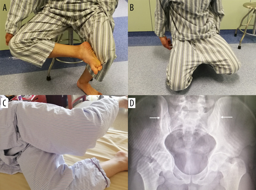 Symptoms, signs, and radiographic findings of a patient with GMC. (A) The patient could not cross his leg while sitting down. (B) The hip joint is fixed in abduction and external rotation when the patient squats and cannot squat with the legs together. (C) The doctor fixed the patient’s pelvis and ankle with the knee flexed at 90°, and then the doctor released the patient, and the patient maintained an upward and abducted position of the affected limb, which was a positive Ober’s sign. (D) Iliac hyperdense line sign (arrow).