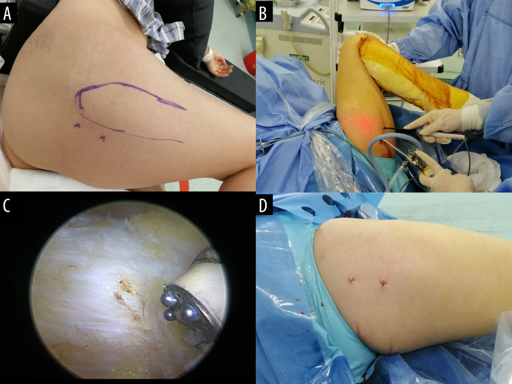 Procedure of the novel arthroscopic surgical approach for GMC patients. (A) Marking the surgical position and portal Including GT, the proximal portal (approximately 1 cm behind the apex of the GT), and the distal portal (4 cm away from the proximal portal). (B) The endoscope was inserted by the proximal portal and the planer or radiofrequency knife was inserted by the distal portal, and the assistant moved the patient’s hip sufficiently to completely expose all contracted muscle tissue. (C) The contracture band was visible under the microscope and released by the radiofrequency knife. (D) Both portals were sutured.