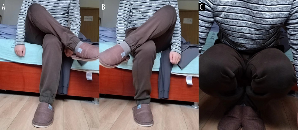 Recovery of symptoms for the patient in Figure 1 (A) and (B) at the follow-up. (A, B) The patient could cross his legs while sitting down. (C) The patient could squat with his legs together.
