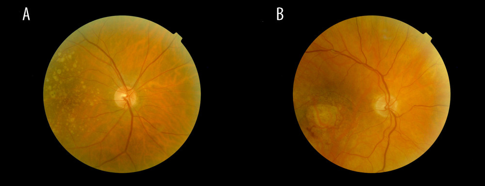 Fundus images of intermediate AMD (A) and late-stage geographic atrophy (B). Image A shows the typical AMD-associated changes in the form of drusen (ie, yellow deposits in the pigment epithelium), as well as pigment epithelium changes in the form of hyperpigmentation. Image B shows atrophy of the retinal pigment epithelium and photoreceptors in the central macula area.