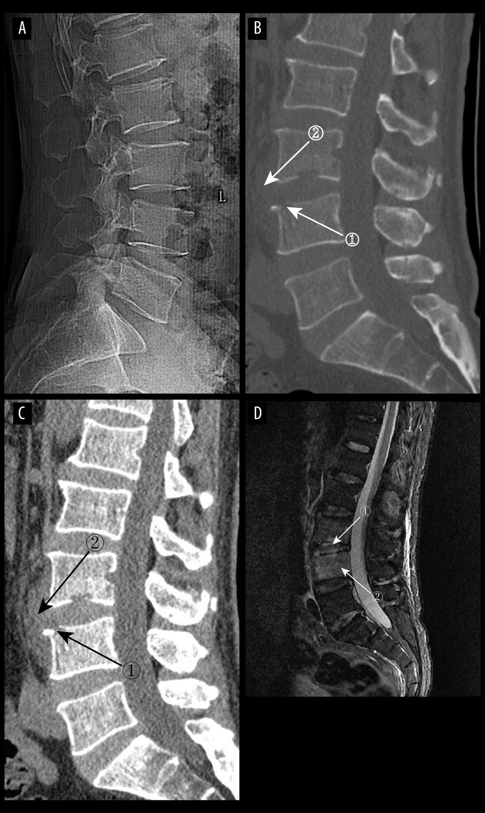 (A) pyogenic spondylitis (PS) early plain radiograph. No significant narrowing of the lumbar spinal space was seen. (A–D) Images of the same patient, who presented with 9 days of low back pain. (B, C) Plain and enhanced computed tomography in early PS. Marker 1 in both images shows poorly defined bony margins on the anterosuperior margin of the L4 vertebral body, and marker 2 shows swelling of the surrounding soft tissues (D) Magnetic resonance imaging in early stages of PS. Marker 1 shows disc erosion, and marker 2 shows diffuse infection of the L4 vertebral body (Adobe Illustrator 2022. 26.5. Adobe Inc.).