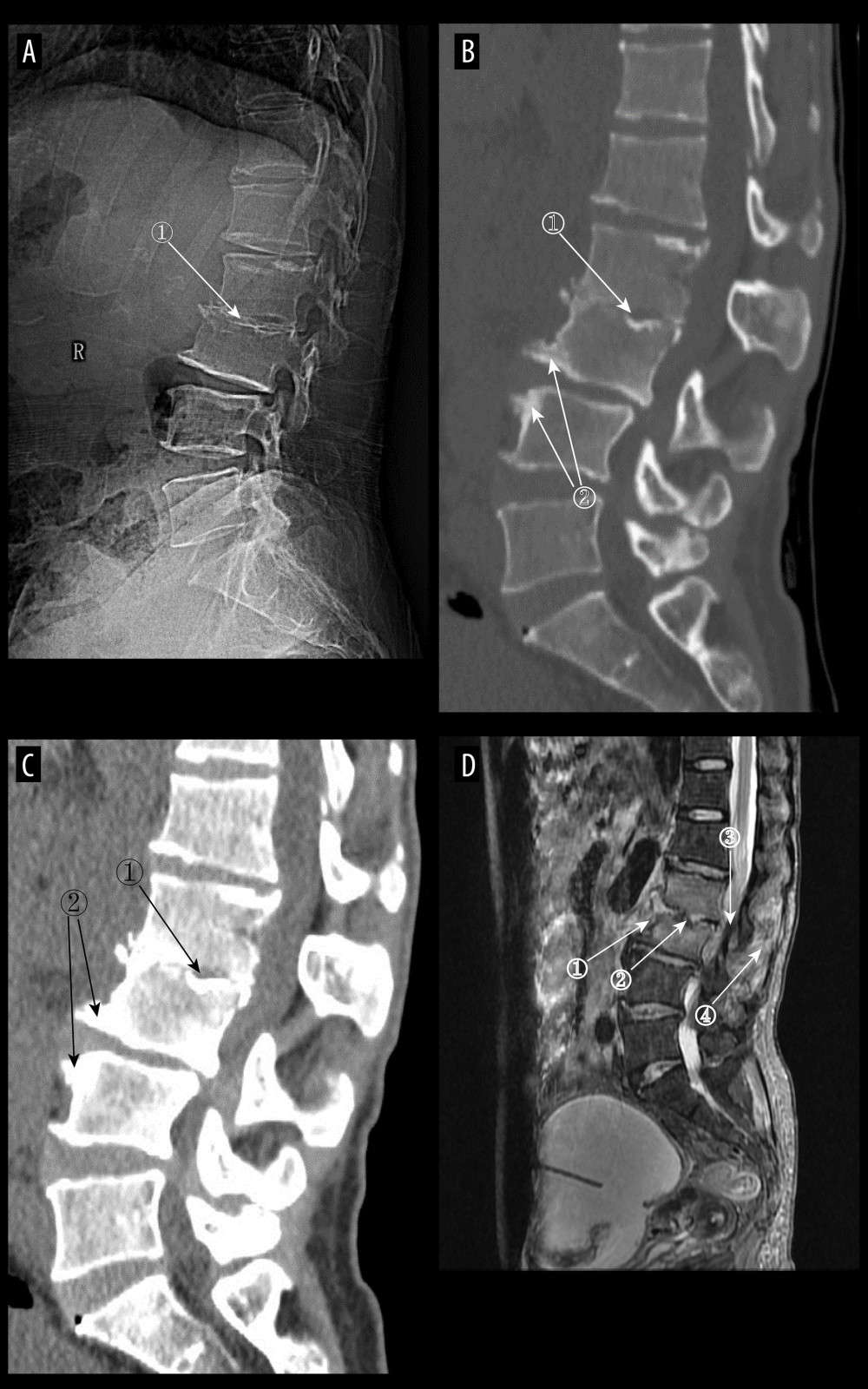 (A) Plain radiographs of late pyogenic spondylitis (PS). Marker 1 shows severe narrowing of the L2–3 intervertebral space, with bony hyperplasia and sharpening of the vertebral margins. (A–D) Images of the same patient, with 42 days between onset of symptoms and the time of the radiograph. (B, C) Plain and enhanced computed tomography in late-stage PS. Marker 1 shows marked narrowing of the L2–3 intervertebral space, and marker 2 shows rough and blurred edges of the L3–L4 vertebral body with osteolytic changes. (D) Magnetic resonance imaging of late PS. Osteolysis of the anterior margin of L3 is shown at marker 1, severe narrowing of the L2–3 intervertebral space is shown at marker 2, osteophytes of the small joints are shown at marker 3, and high signal of the lumbar attachments is shown at marker 4 (Adobe Illustrator 2022. 26.5. Adobe Inc.).
