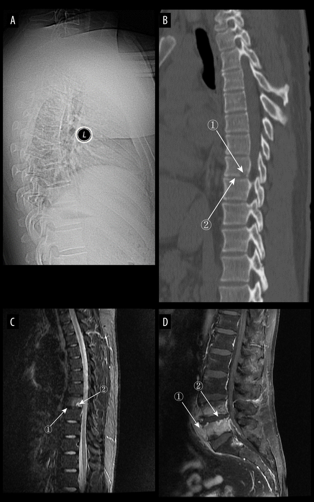 (A) Plain radiograph of early tuberculous spondylitis (TS). No abnormal vertebral changes. (A–C) Images of the same patient, with an interval of 120 days between onset of symptoms and the first radiograph. (B) Plain computed tomography in early TS. There is a less dense lesion with poorly defined borders and no obvious sclerotic bands at marker 1, and an uneroded disc is visible at marker 2. (C) Magnetic resonance imaging (MRI) in early stages of TS. Marker 1 shows that the disc has not received erosion and marker 2 shows an abnormal high signal lesion in the T8 vertebral body. (D) MRI in early stages of TS. Marker 1 shows an abnormally reinforcing shadow in the paravertebral soft tissue, and marker 2 shows relative preservation of the disc, at 120 days between symptom onset and radiograph in this patient (Adobe Illustrator 2022. 26.5. Adobe Inc.).