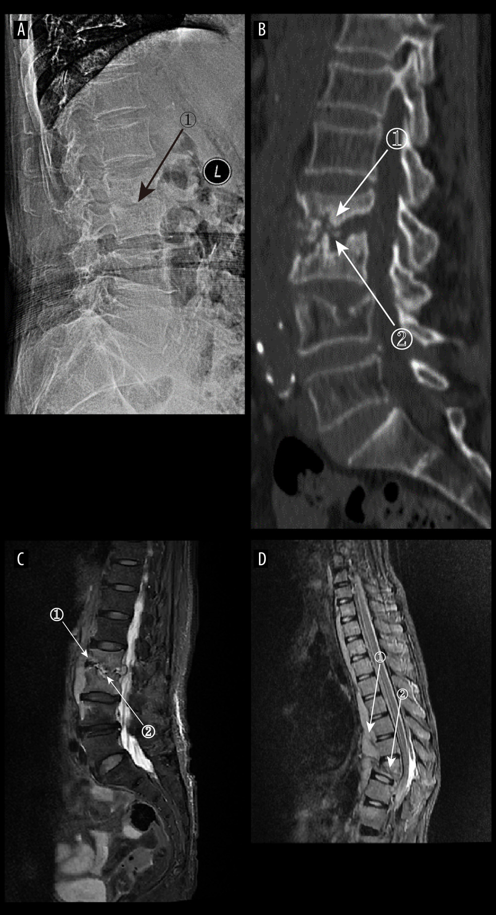(A) Plain radiographs of late tuberculous spondylitis (TS). Marker 1 shows narrowing of the L2–3 intervertebral space, dysmorphism of the L2 vertebral body, and osteophytes on the margins. (A–C) Images of the same patient, with an interval of 210 days between the onset of the disease and the radiographs. (B) Plain computed tomography in late-stage TS. Markers 1 and 2 show severe bone destruction at the lower edge of the L2 vertebral body and the upper edge of the L3 vertebral body, narrowing of the L2–3 intervertebral space, and free osteolysis. (C) Magnetic resonance imaging (MRI) of late TS. Marker 1 shows abnormal signal in the paravertebral region, and marker 2 shows bone destruction at the opposite edges of the L2 and L3 vertebrae. (D) MRI of late TS. Marker 1 shows sublimated spreading of an abscess under the anterior longitudinal ligament, and marker 2 shows thoracic vertebral deformity. This is an image of a patient who was approximately 130 days from the onset of symptoms to radiography (Adobe Illustrator 2022. 26.5. Adobe Inc.).