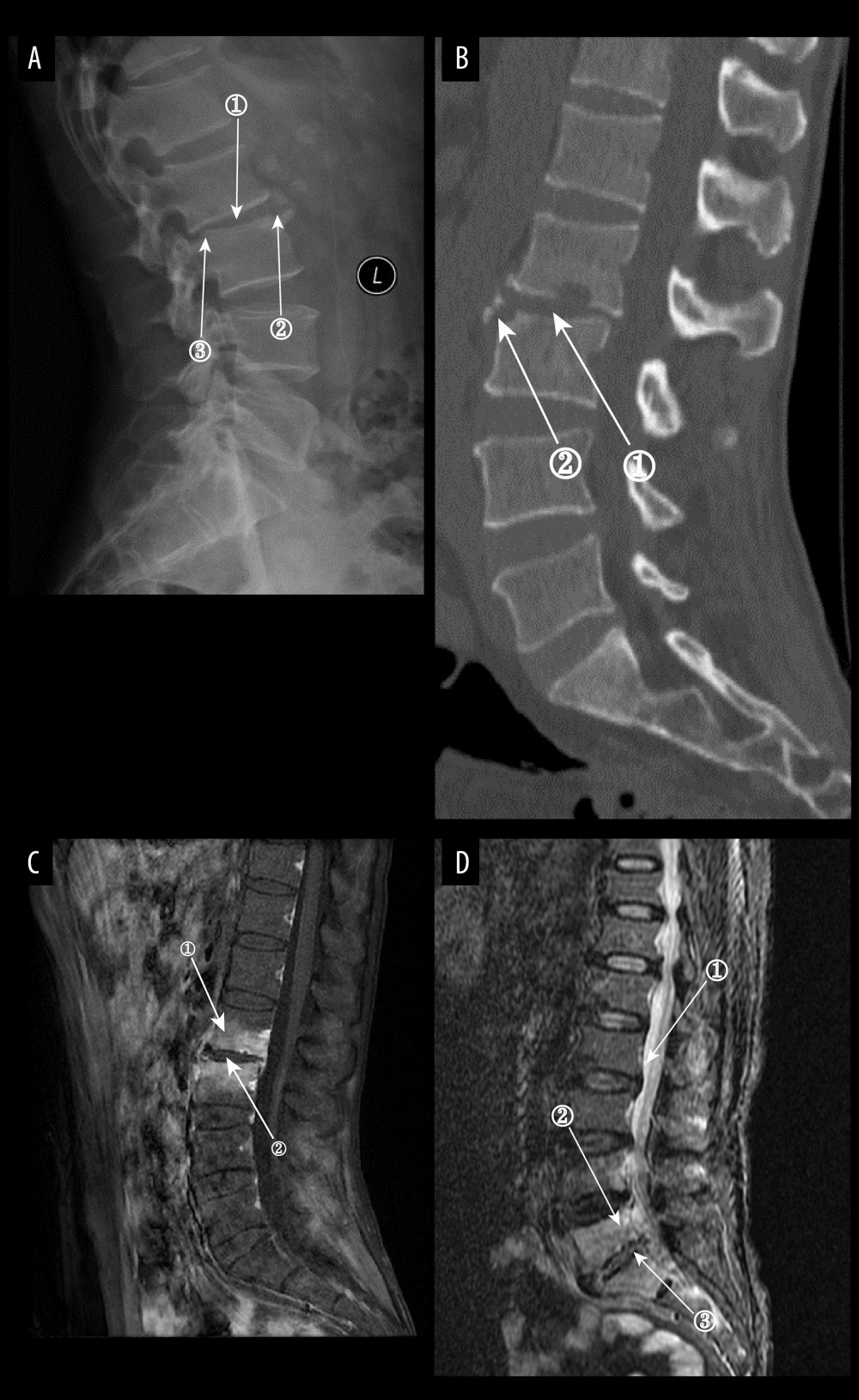 (A) Plain radiographs of late Borrelia burgdorferi spondylitis (BS). Marker 1 shows a decrease in the height of the intervertebral space, marker 2 shows osteophytes on the margins of the vertebral body, and marker 3 shows a slight forward displacement of the L3 vertebral body. (A–D) Images of the same patient, with an interval of approximately 120 days between the onset of symptoms and the time of the radiograph. (B) Plain computed tomography in late BS. In both figures, Marker 1 shows a decrease in the height of the intervertebral space, and marker 2 shows hyperplasia of the anterior margin of the vertebrae. (C) Magnetic resonance imaging (MRI) of late BS. This image is a T1-enhanced image showing abnormal signal in the vertebral body at marker 1 and reduced intervertebral space height in the vertebral body at marker. (D) MRI of late BS. Density at marker 1 is 54, marker 2 shows diffuse infection of the vertebral body with a density of 37, and marker 3 shows an infected disc. The time between the onset of this patient’s disease and the radiograph is about 2 years. (ITK-SNAP. Version 4.0.2. Paul Yushkevich, Jilei Hao, Alison Pouch, Sadhana Ravikumar et al at the Penn Image Computing and Science Laboratory; Adobe Illustrator 2022. 26.5. Adobe Inc.).