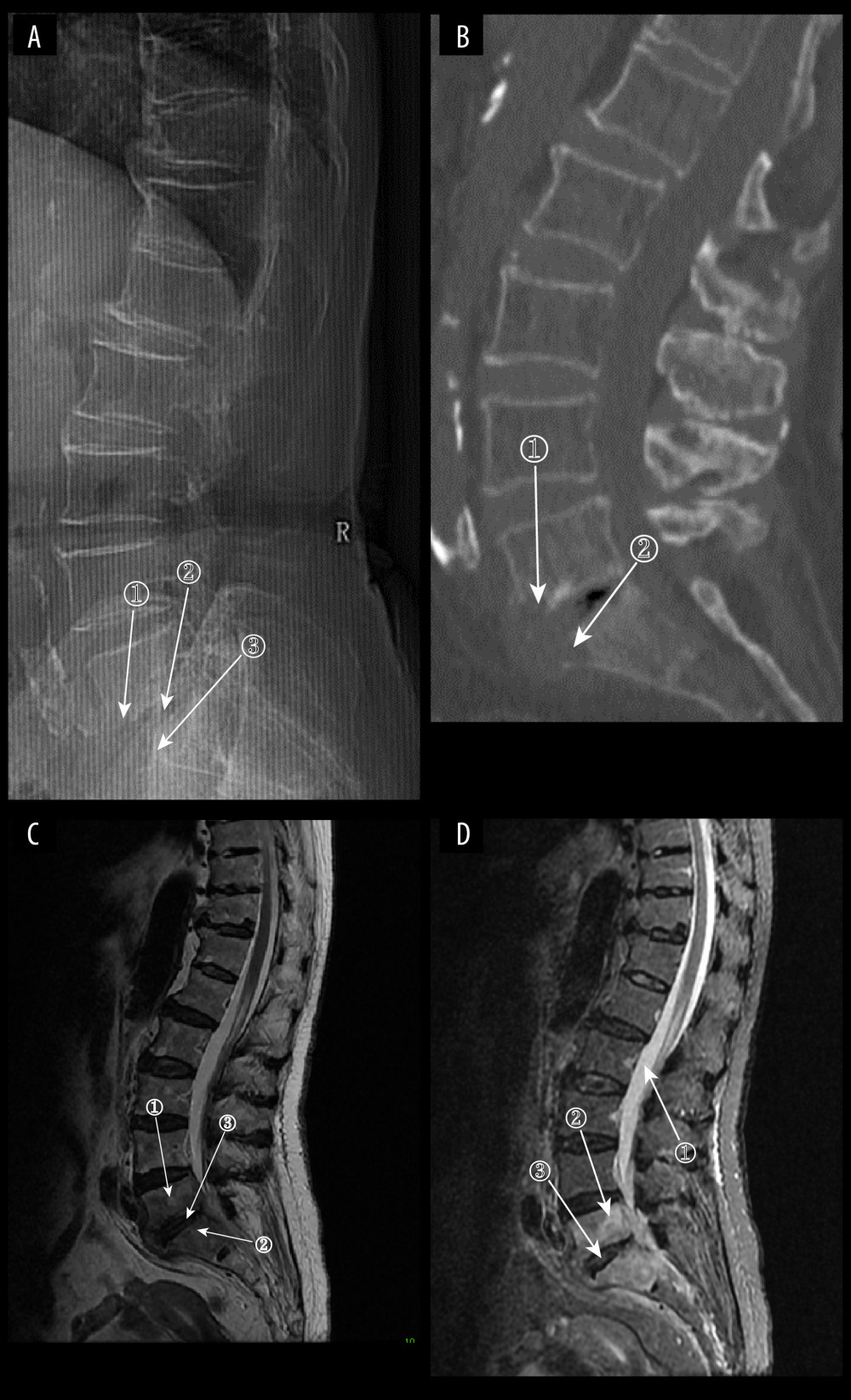 (A) Plain radiograph of early fungal spondylitis (FS). Markers 1 and 3 show localized bone destruction at L5–S1, and marker 2 shows no significant narrowing of the intervertebral space. (A–C) Images of the same patient, who had an interval of approximately 30 days between the onset of symptoms and the time of the radiographs. (B) Plain computed tomography in early FS. Bone destruction is seen in the margins of the L5–S1 vertebrae at markers 1 and. (C) Magnetic resonance imaging (MRI) in early stages of FS. This image is a T2WI sequence. A small intraosseous abscess is shown at marker 1, a striated shadow under the vertebral endplate is shown at marker 2, and an infected disc is shown at marker. (D) MRI in early stages of FS. This image is a short Tau inversion recovery (STIR) sequence. Density at marker 1 is 376, marker 2 shows diffuse high signal in the vertebral body with a density of 312, which is lower than the cerebrospinal fluid density value, and marker 3 shows a relatively preserved intervertebral space height (ITK-SNAP. Version 4.0.2. Paul Yushkevich, Jilei Hao, Alison Pouch, Sadhana Ravikumar et al at the Penn Image Computing and Science Laboratory; Adobe Illustrator 2022. 26.5. Adobe Inc.).
