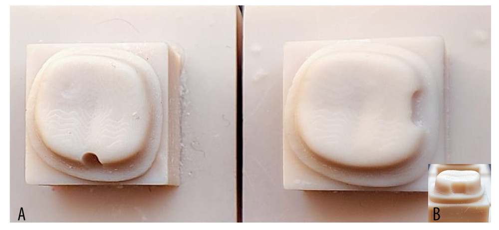 (A) 20-degree taper 3D-printed models on which auxiliary retentive groove (buccal) and box (proximal) were prepared. (B) Inset showing proximal view of the box preparation. Photograph taken using a digital single-lens reflex (DSLR) camera (Canon EOS 700D) with 100 mm macro lens) with/without ring flash followed by compilation on MS PowerPoint, version 20H2 (OS [operating system] build 19042,1466), Windows 11 Pro, Microsoft [MS] Corporation.