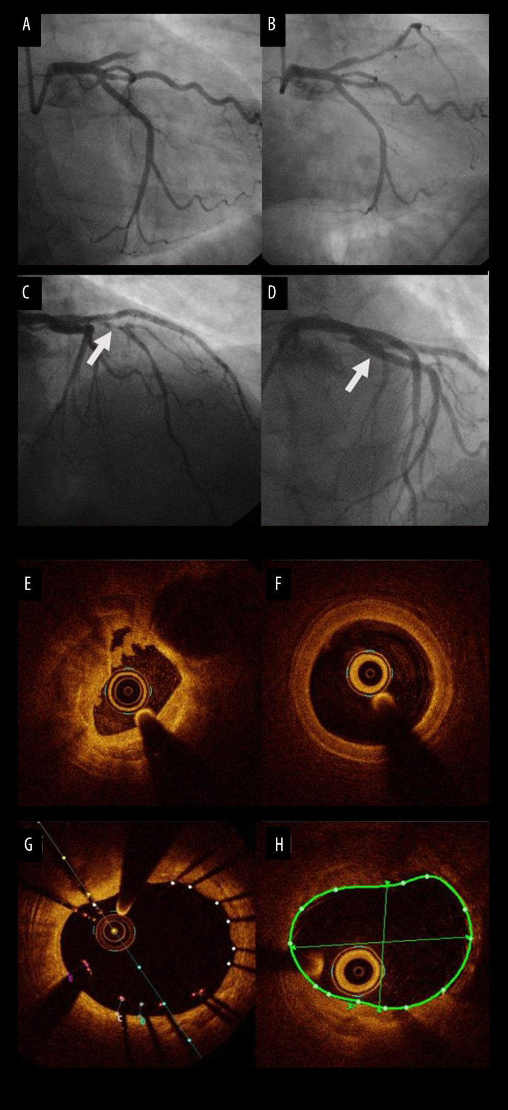 A 58-year-old woman presented with acute anterior wall ST elevation myocardial infarction. (A) the left coronary angiogram showed the culprit lesion thrombotic occlusion at proximal left anterior descending artery (LAD), with a right anterior oblique caudal view. (B) The left coronary angiogram after thrombus suction. (C) The arrow shows the culprit site after thrombus suction, with a right anterior oblique cranial view. (D) The arrow shows the result after drug-eluting stent (DES) and optical computed tomography (OCT)-guided percutaneous coronary intervention (PCI). (E) OCT finding at the culprit site, with much thrombus and minimal luminal area (MLA) only 1.9 mm2 after thrombus suction. (F) OCT finding at the LAD reference site, with MLA 4.7 mm2. (G) OCT finding at the culprit site after DES implantation. (H) OCT finding at the LAD reference site.