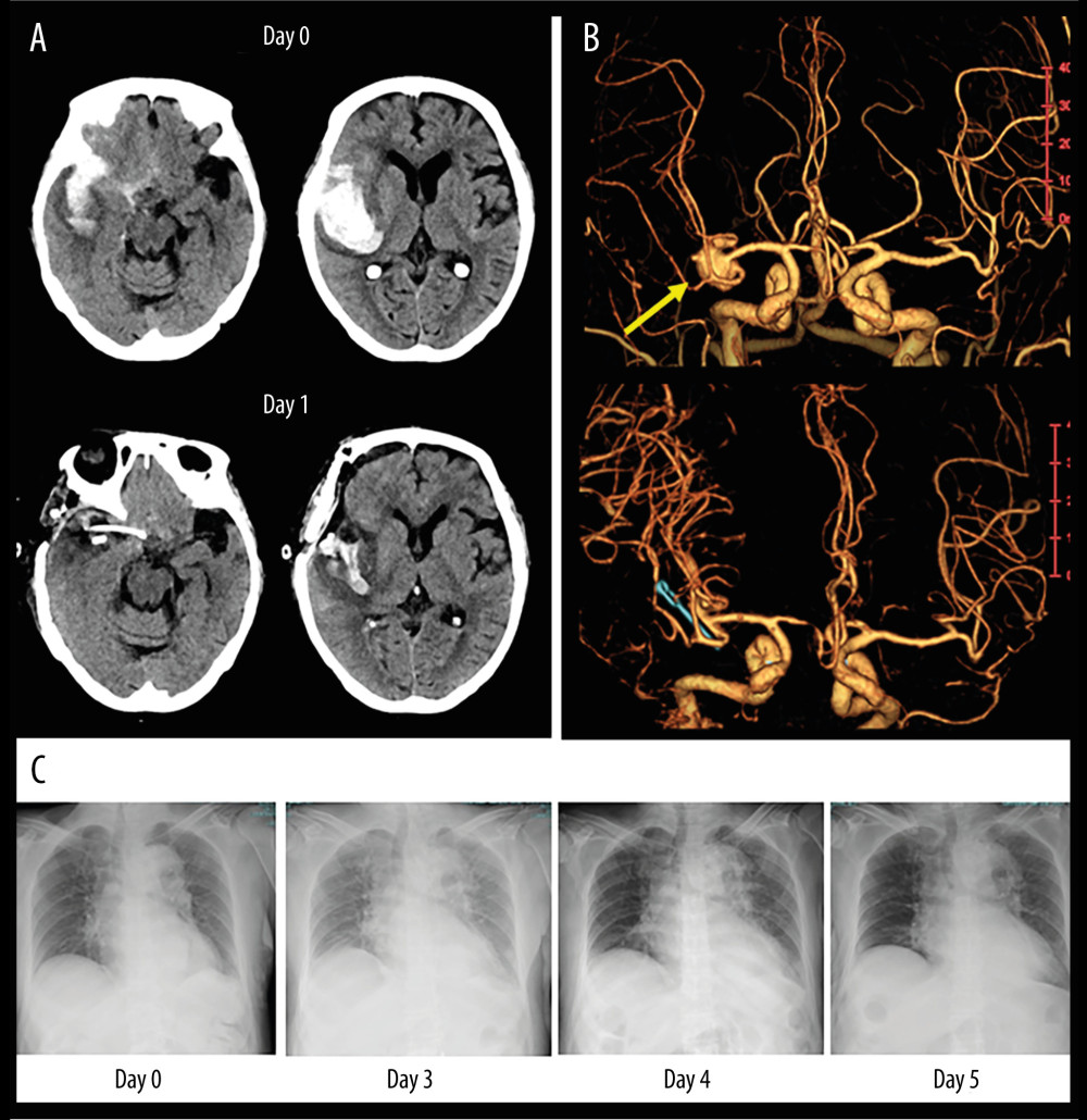 An illustrative case of 81-year-old woman with SAH caused by ruptured aneurysm in right middle cerebral artery. (A) Non-contrast CT images on admission (upper panel) and postoperative day 1 (lower panel). (B) Volume-rendering enhanced CT angiography images on admission shows a large aneurysm in the right middle cerebral artery (yellow arrow) compatible with the clot distribution. (C) Serial changes of chest X-ray images before and after clazosentan therapy. CT – computed tomography; SAH – subarachnoid hemorrhage.
