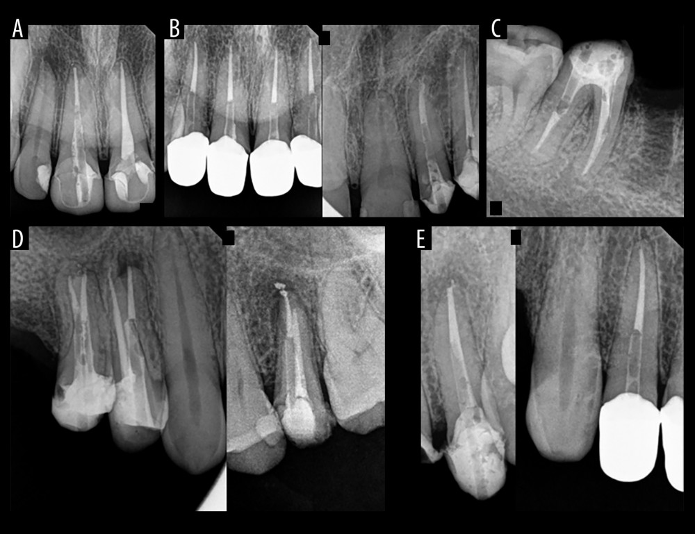 Different parameters used of the GFPs: post width (A), post length in relation to crown and root lengths (B), amount of remaining GP (C), presence of any radiographic abnormality (D), and spaces between the end of post and residual GP (E).