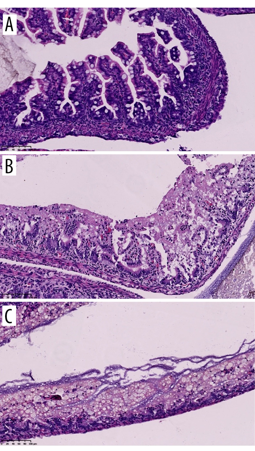 Histology: hematoxylin-eosin (HE) staining. Samples of the small intestine representing different levels of the NEC grading scale. A: grade 0 – normal intestine, B: grade I – submucosal and lamina propria separation with oedema of the submucosa, C: grade II – villi loss and necrosis. Source: Own materials, NDP.view2 software (Hamamatsu, Japan).