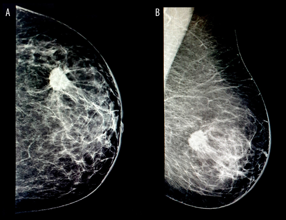 The clinically non-palpable mass with irregular shape and indistinct margins on left craniocaudal (A) and left mediolateral oblique (B) mammographic images of a 64-year-old woman with focal breast pain. The patient initially reported breast pain and was subsequently diagnosed with invasive ductal cancer.