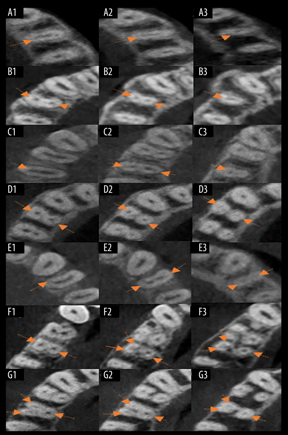 Representation of root canal classifications on axial view of CBCT. (A1–A3) Presence of single canals in the coronal, middle, and apical thirds indicated by arrows, classified as Vertucci Type I and 1TN1 Ahmed. (B1, B2) Two canals in the coronal and middle third. (B3) Only 1 canal in the apical third, indicated by arrows, classified as Type II Vertucci and 1TN2-1 Ahmed. (C1) One canal in the coronal third. (C2) Two canals in the middle third. (C3) One canal in the apical third indicated by arrows, classified as Type III Vertucci and 1TN1-2-1 Ahmed. (D1–D3) Two canals in the coronal, middle, and apical thirds indicated by arrows, classified as Type IV Vertucci and 2TNB1P1 Ahmed. (E1) One canal in the coronal third. (E2, E3) Two canals in the middle and apical third indicated by arrows, classified as Type V Vertucci and 1TN1-2 Ahmed. (F1) Two canals buccal and palatal in coronal third. (F2, F3) Two canals in buccal and 1 canal in palatal root in middle and apical thirds, indicated by arrows, classified as 2TNB1-2P1 according to Ahmed and Type XVI according to Sert and Bayirli. (G1–G3) Three canals in coronal, middle, and apical third indicated by arrows, classified as Type VIII Vertucci and 3TNMB1DB1P1Ahmed.