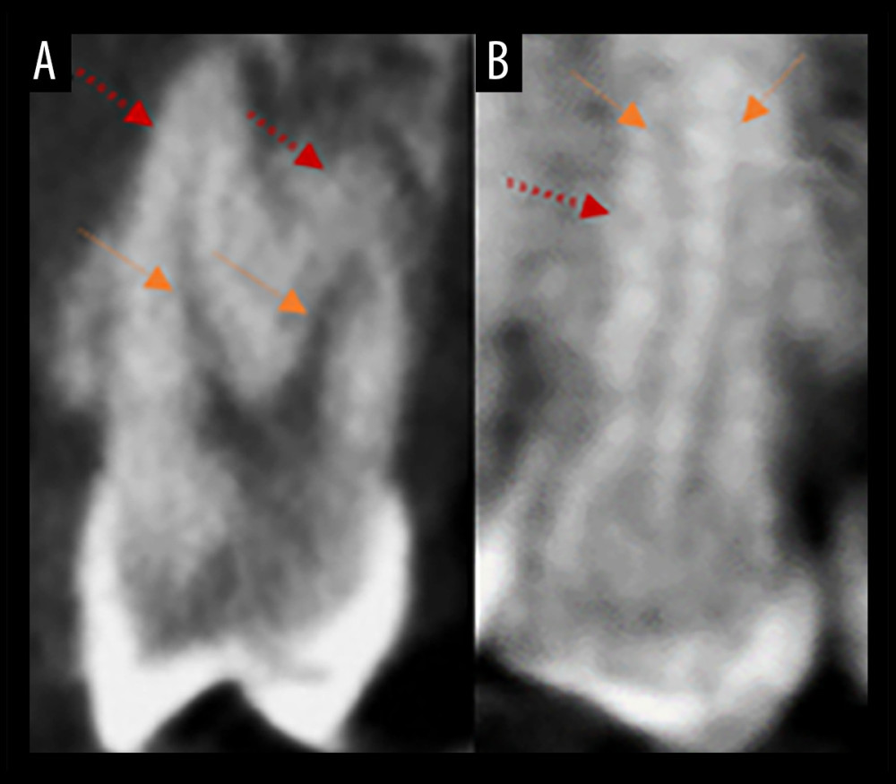 Need for use of Ahmed classification. (A) Two roots with 2 canals. (B) Two 2 canals in 1 root (root indicated by red arrows and canals indicated by orange arrows).