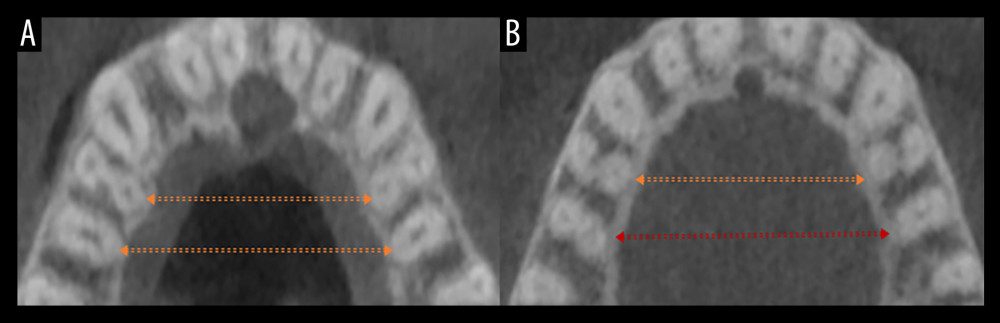 Bilateral symmetry among opposing quadrants. (A) Symmetrical root and root canal classification in both maxillary first premolars (MFP) and maxillary second premolars (MSP). (B) Symmetry among MFP but asymmetrical root and canal classification among bilateral MSP. The arrows (orange) indicate symmetry and arrow (Red) indicates asymmetry.