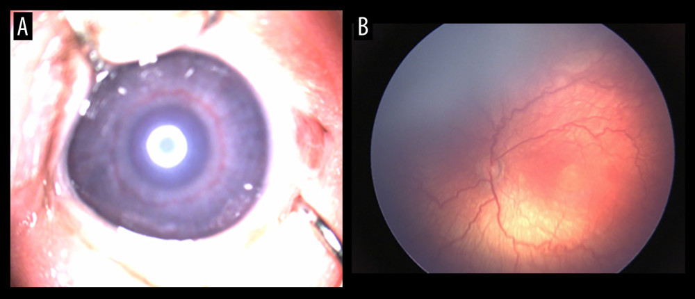 Digital images obtained using RetCam Shuttle, representing (A) iris vascular engorgement and (B) the posterior pole with presence of arteriolar tortuosity and venular dilatation. Courtesy of Dr. Florina Stoica’s personal collection. Used with permission.