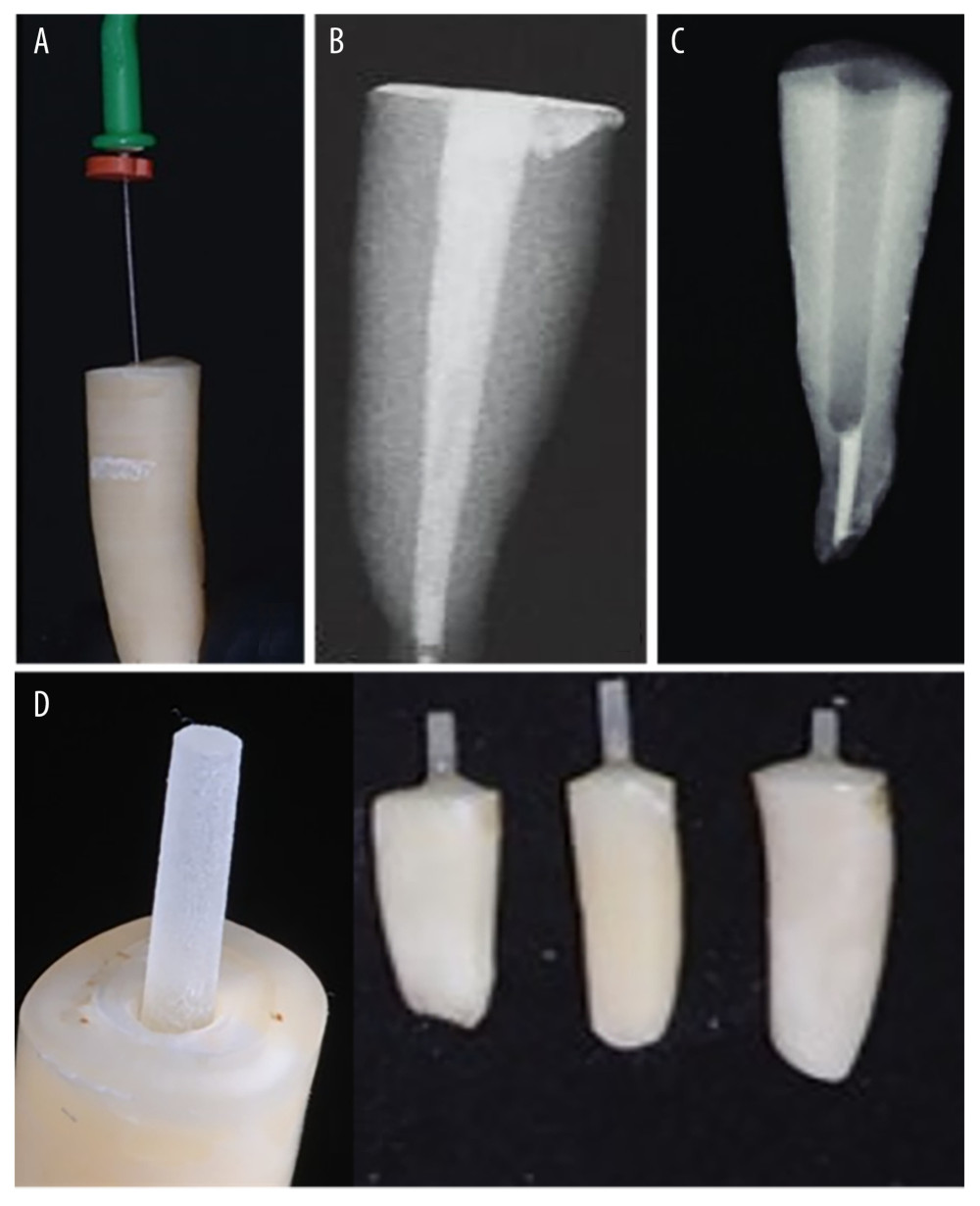 During endodontic treatment, (A) working length, (B) filling the canal with gutta percha, (C) post space preparation, and (D) after cementation of posts.