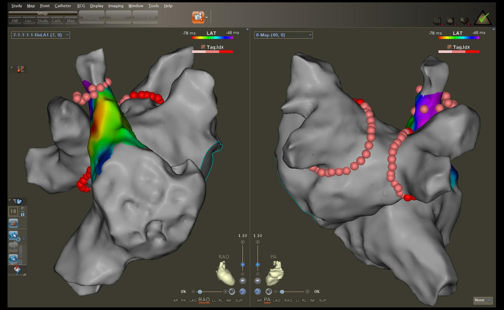 Radiofrequency (RF) applications to the pulmonary vein antrum and superior vena cava isolation (SVCI) on the reconstructed left atrium and right atrium electroanatomical maps. The left panel illustrates the right anterior oblique view, and the right panel displays the posteroanterior view.