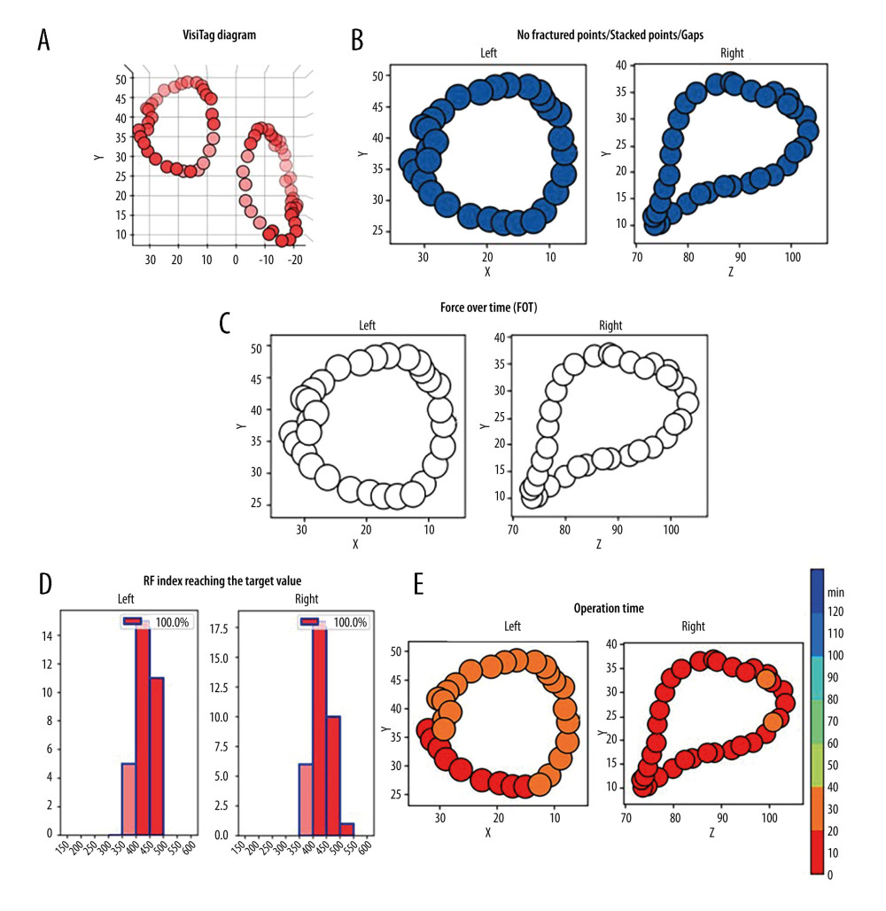 Representative case evaluated by an artificial intelligence analytics platform. (A) The original VisiTag diagram. (B) No fractured points (black arrow), stacked points, and gaps in bilateral pulmonary vein isolation (PVI) circles. (C) The proportion of contact force (CF) meeting force over time (FOT) was 100% in bilateral PVI circles. (D) The proportion of radiofrequency (RF) index reaching the target value was 100% in bilateral PVI circles. (E) The operation time of performing bilateral PVI circles was less than 40 min.