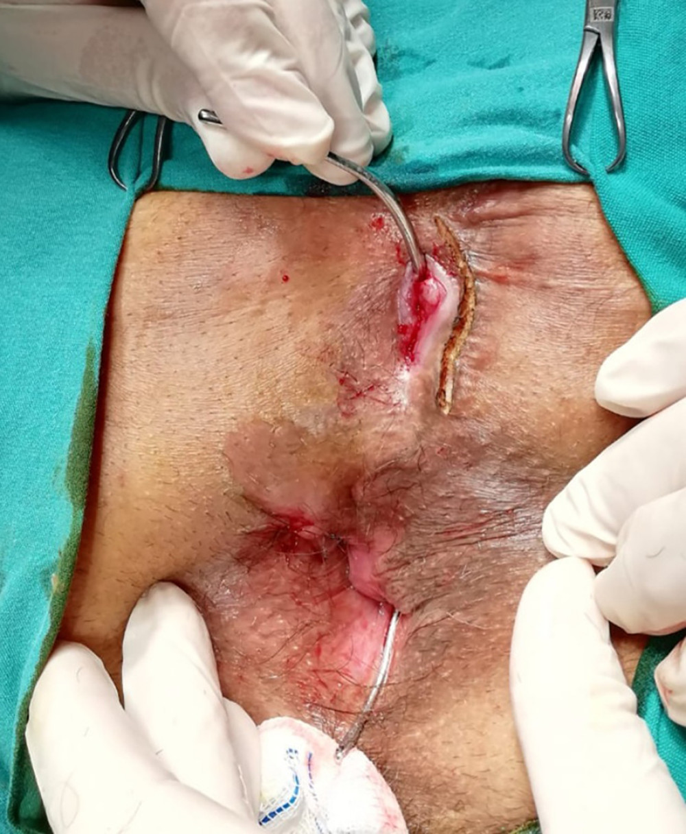 Transsphincteric perianal fistula in a human immunodeficiency virus (HIV)-positive patient. The patient underwent a partial fistulotomy and seton procedure.