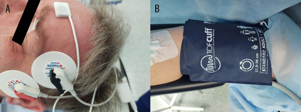 Placement of devices (A) TOF-Scan and (B) TOF-Cuff.
