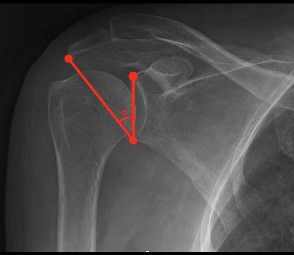 Critical shoulder angle (CSA) measurement technique. A line connecting the most lateral points of the superior and inferior borders of the glenoid is drawn. Then, a second line extending from the inferior glenoid to the most lateral point of the acromion is drawn. The angle formed between the 2 lines is defined as the CSA (Powerpoint, Office for Mac,2023 version: 16.74; Redmond, Washington, USA).