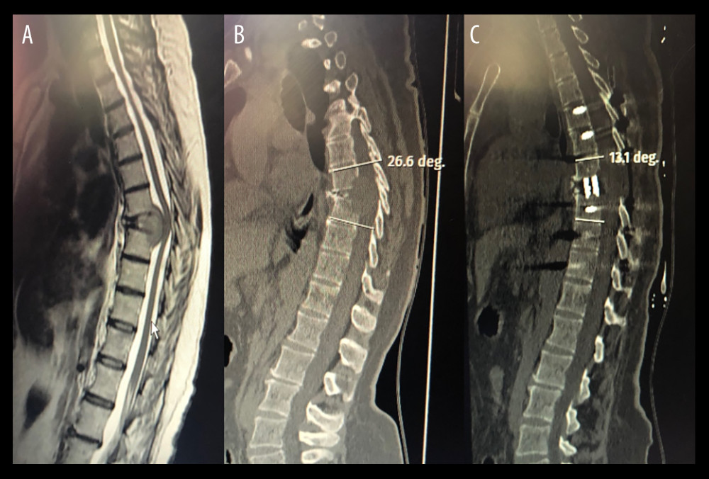 (A) Pre-operative T2-weighted MRI showing a tumor located at thoracal eighth vertebra. (B) Pre-operative CT image showing kyphotic angulation caused by tumor. (C) Postoperative CT image after reconstruction of kyphosis with an expandible cage insertion.