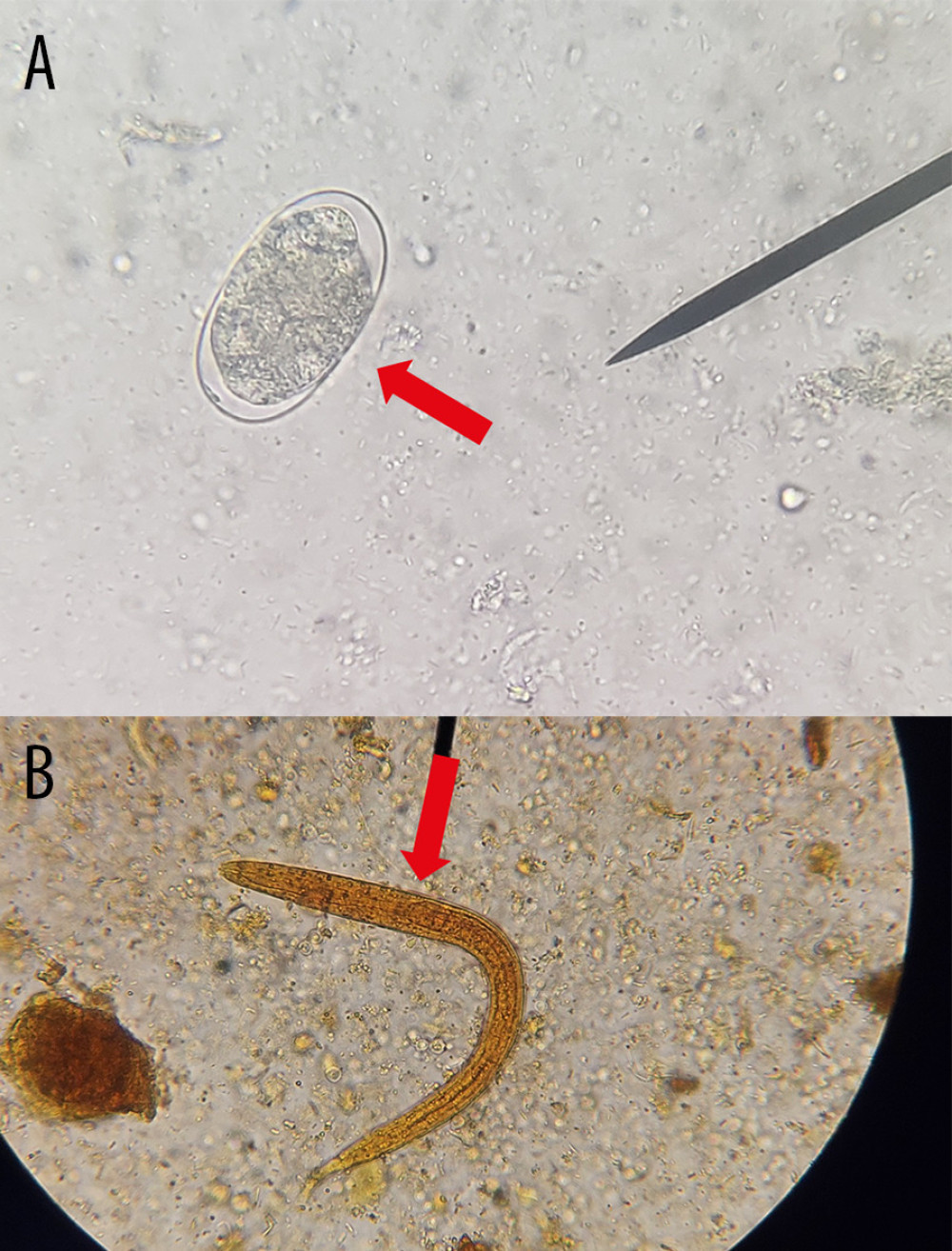 Microscopic identification of (A) egg of Ancylostoma spp. (red arrow) through the technique of sedimentation by centrifugation using saline solution and (B) larvae of Ancylostoma spp. (red arrow) obtained by the technique of modified Baermann, in the feces of domestic dogs observed by optical microscopy at 40× and stained/not with Lugol. (Taken by the authors).