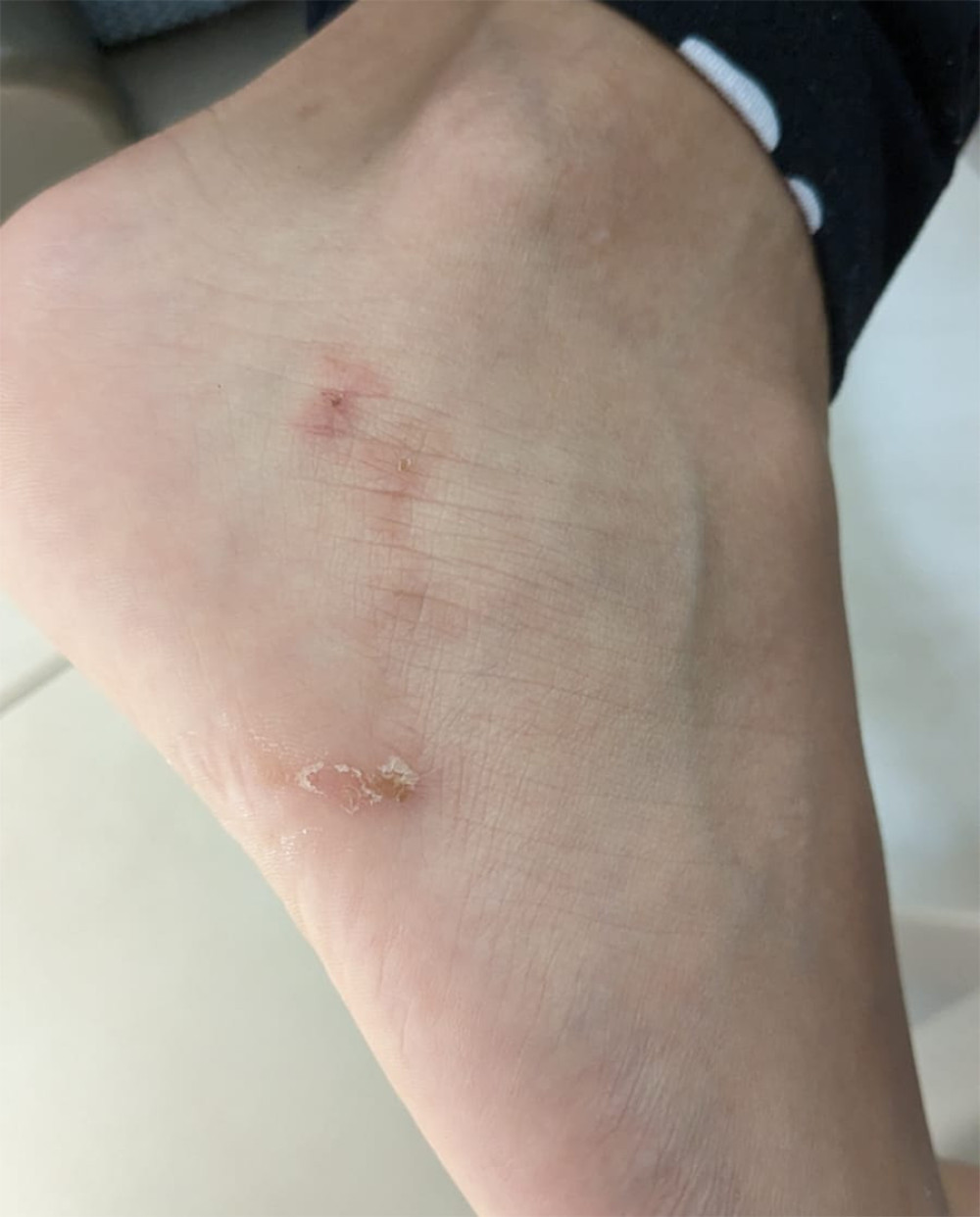 A 14-year-old boy with a palpable serginous lesion on his right foot was diagnosed with cutaneous larva migrans (MCI). (Taken by the authors).