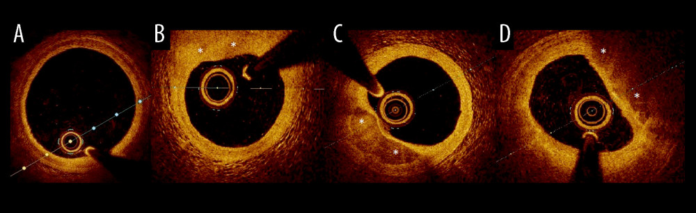 Examples of plaque types in optical coherence tomography. (A) Healthy vessel (normal three-layer artery wall visible), (B) Fibrous plaques (homogenous signal, high backscattering), (C) Calcified plaque (signal-poor heterogeneous region with sharply delineated border), (D) lipid-rich plaque (inhomogeneous signal-poor region with diffused borders). Plaques are marked with an *.