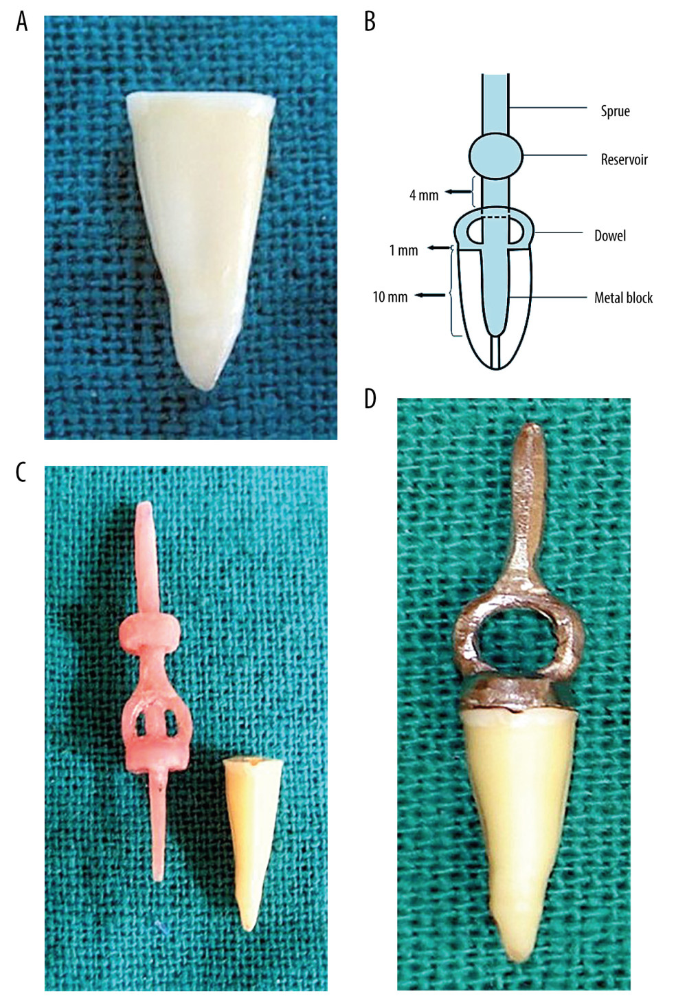(A) Extracted mandibular second premolar after decoronation. (B) Schematic diagram showing the design of the cast post core and its various dimensions relative to the length of the root. (C) Prepared pattern for cast post core against the back drop of its specimen. (D) Raw cast post core seated on the extracted tooth showing marginal adaptation. Photographs taken using digital single-lens reflex (DSLR) camera (Canon EOS 700D) with 100 mm macro lens) with/without ring flash. Figure created using MS PowerPoint, version 20H2 (OS build 19042,1466), Windows 11 Pro, Microsoft corporation).