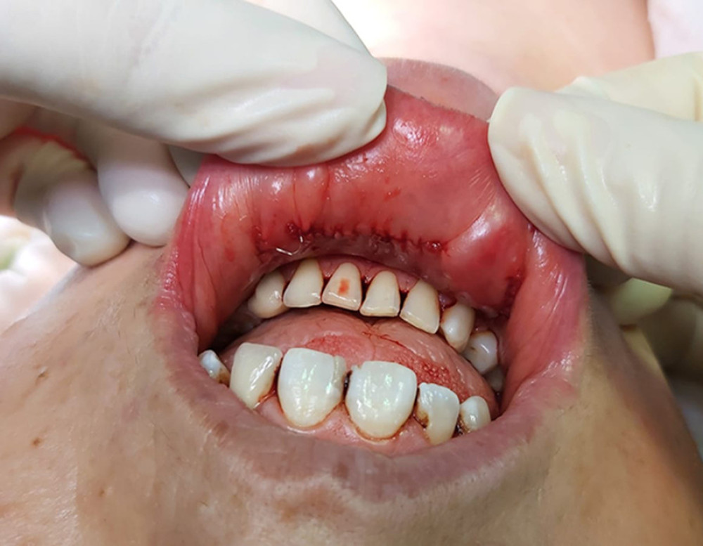 Posteoprative view of lip after TOEPVA. After controlling bleeding in the lip mucosa, the incisions were closed with 4/0 monocryl absorbable suture material.