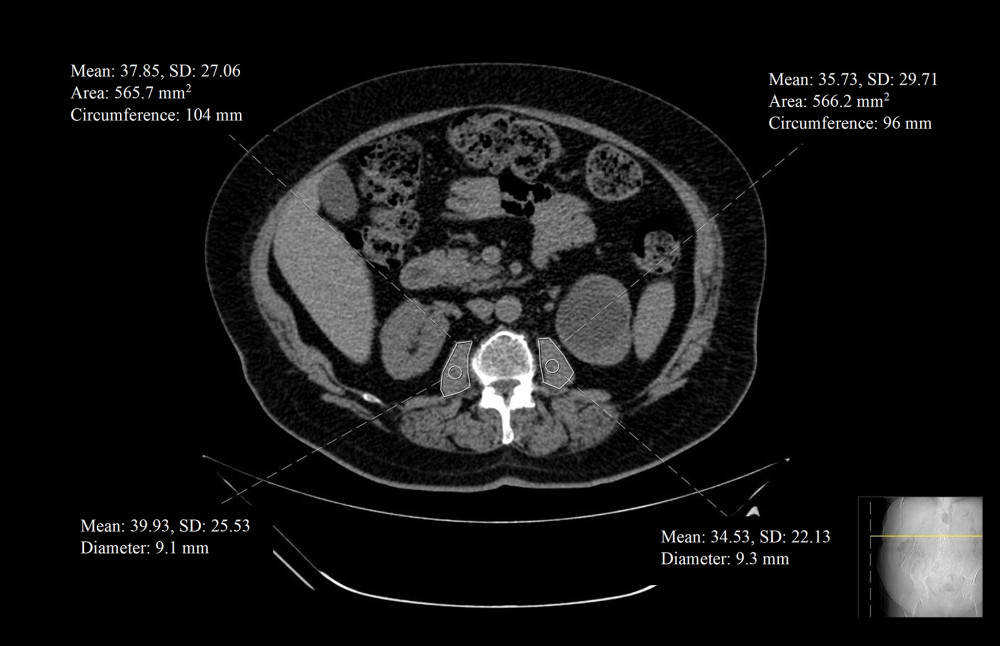 A single radiologist measured the cross-sectional transverse areas of the bilateral psoas muscles by manual tracing on the CT images at the middle level of the third lumbar vertebra using a software program (Sectra Workstation IDS7 Version: 25.2.15.7682 #2014 Sectra AB). The PMI, in mm2/m2 is calculated by normalizing the psoas muscle area for height in meters squared. CT – computed tomography; PMI – psoas muscle index.