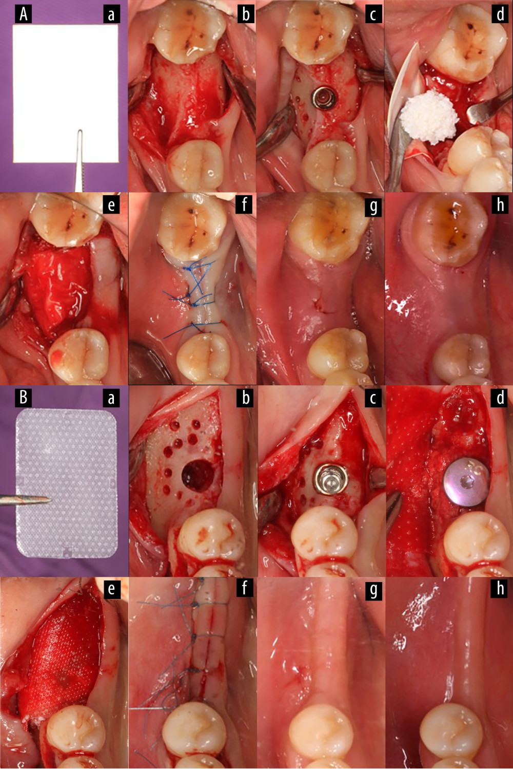 Surgical procedure for simultaneous implantation of guided bone regeneration (Canon EOS 6D, Tokyo, Japan). (A) Experimental group, (B) Control group. (a) Gelatin/polylactic acid (GT/PLA) barrier membrane (Aa) or Guidor® barrier membrane (Bb); (b) Hole preparation; (c) Implant placement; (d) Bone grafting placement on the labial plate; (e) Membrane coverage; (f) Suture to close the wound; (g) Review 2 weeks postoperatively; (h) Review 6 months postoperatively. (Keynote 8.1, Apple, Inc).