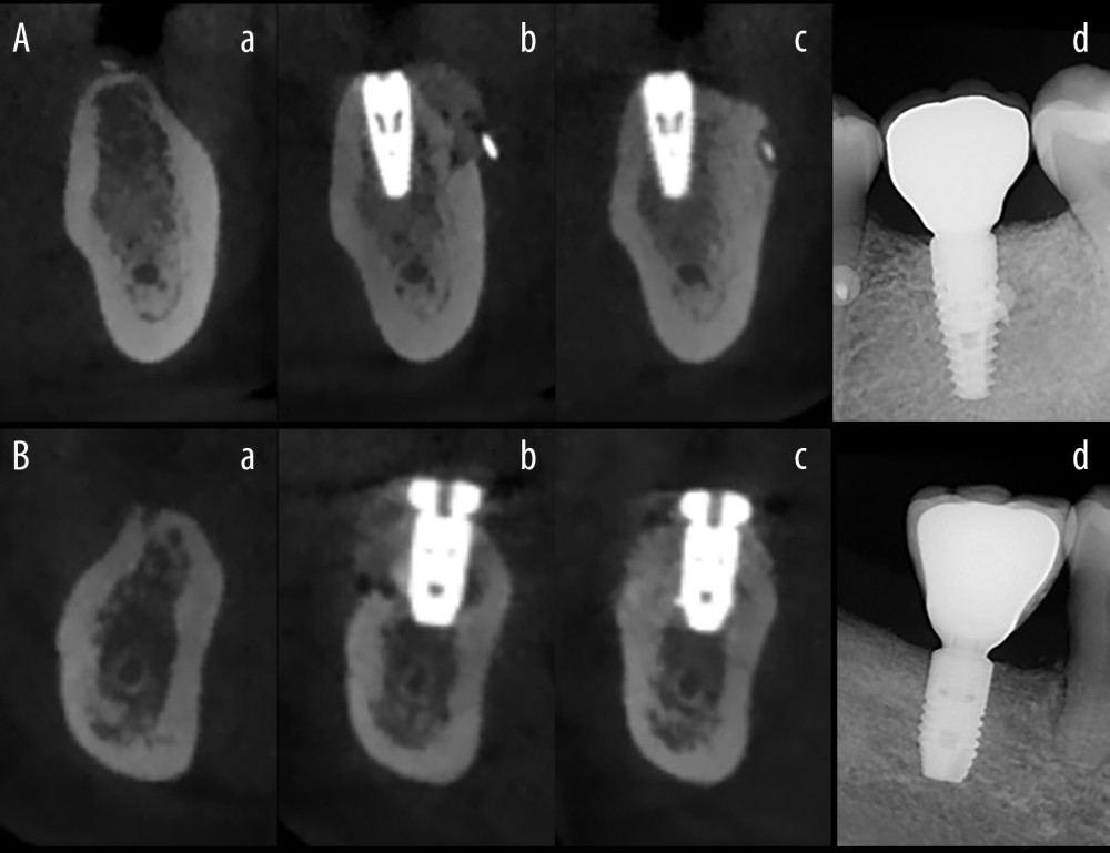 The radiographic images. (Beijing Langshi Equipment Co., Ltd.) (A) Experimental group, (B) Control group. (a) Before the operation; (b) On the day after the operation; (c) At 6 months postoperatively; (d) On the day after crown restoration. (Keynote 8.1, Apple, Inc).