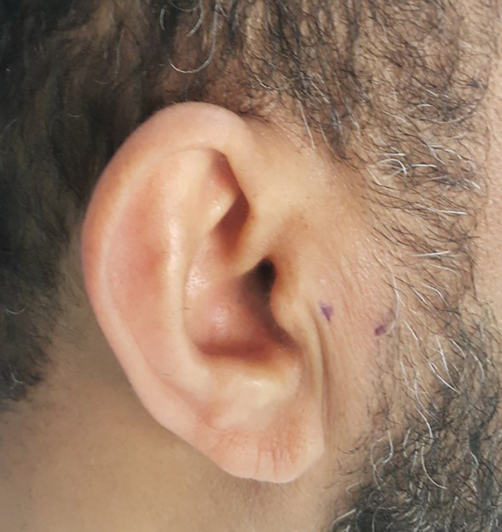 Prolotherapy injection site markings.
