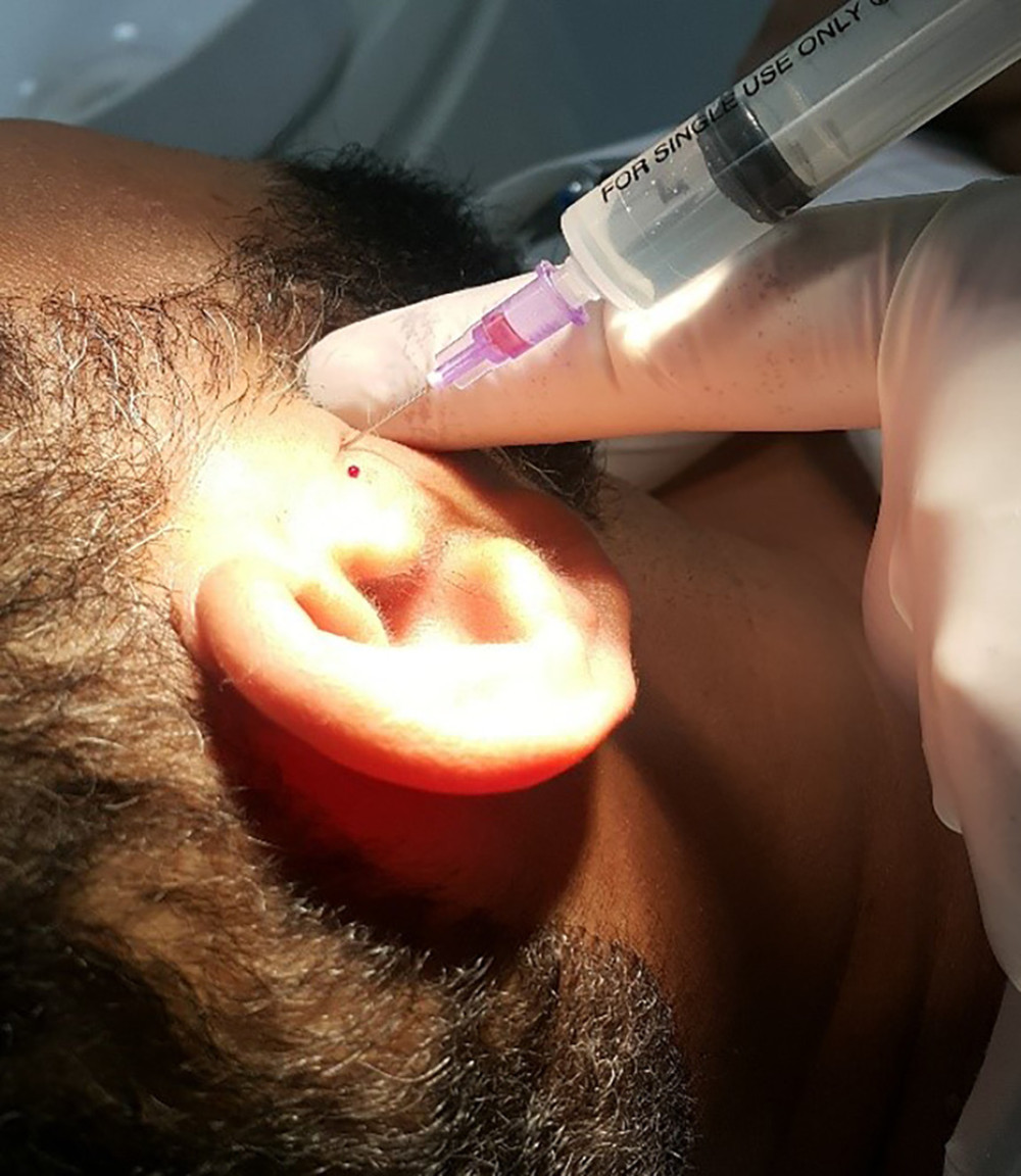 Prolotherapy needle insertion. Injection procedure (point a and point b).